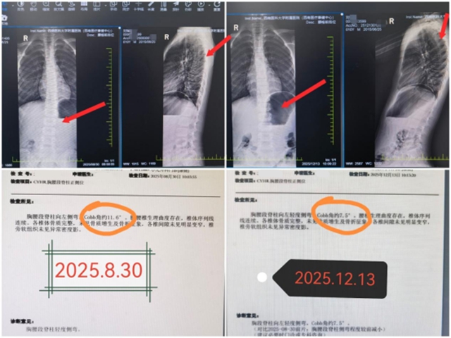 青少年脊柱侧弯!体态矫正!西南医大附院暑期训练营开始了!(图8) 体8.jpg