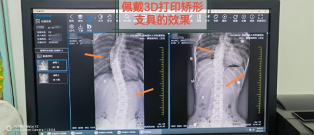 青少年脊柱侧弯!体态矫正!西南医大附院暑期训练营开始了!(图10) 体10.jpg