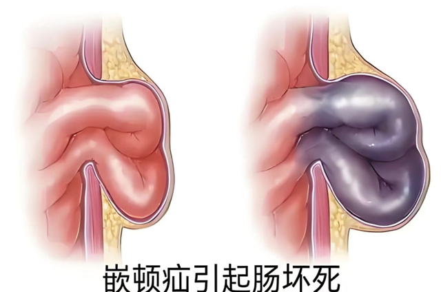 【科普】肚子上鼓了个“包”?别不当回事!(图6) 气6.jpg
