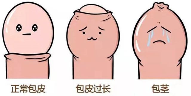 家有男宝别瞎焦虑!包皮要不要割?看这3种情况就够了(图3) 皮3.jpg