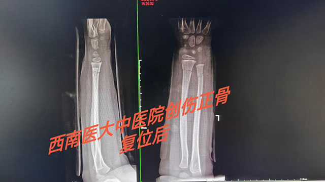 多名小孩手臂被da弯,结果……(图3) 3.jpg
