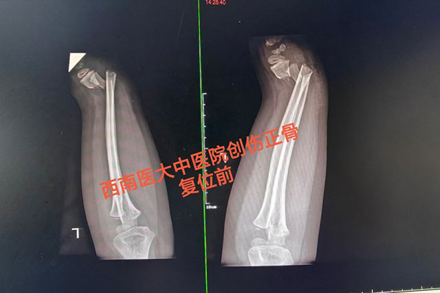 多名小孩手臂被da弯,结果……(图2) 2.jpg