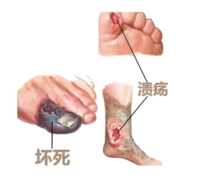 【科普】“糖友”注意,脚丫子出现这些症状警惕糖尿病足!(图3) 足3.jpg