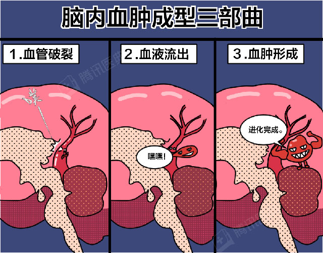 【科普】29岁,脑出血!您还敢熬夜?(图1) 1.jpg