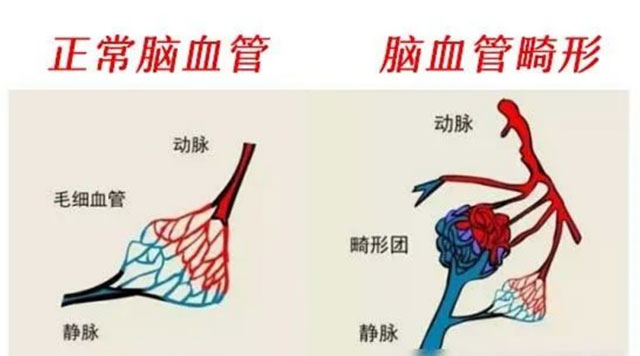 【科普】29岁,脑出血!您还敢熬夜?(图6) 6.jpg
