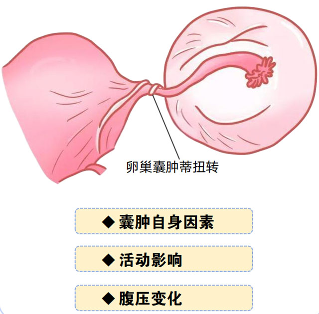 17岁女孩腹痛呕吐,卵巢扭了540度成“麻花”(图4) 4.jpg