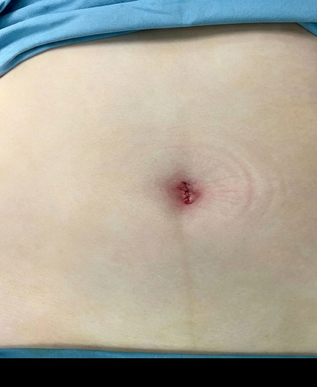 17岁女孩腹痛呕吐,卵巢扭了540度成“麻花”(图2) 2.jpg