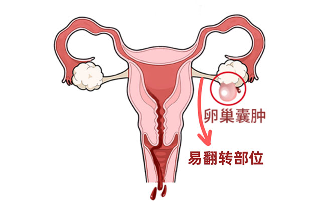 17岁女孩腹痛呕吐,卵巢扭了540度成“麻花”(图3) 3.jpg