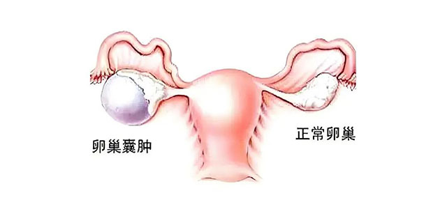 17岁女孩腹痛呕吐,卵巢扭了540度成“麻花”(图5) 5.jpg