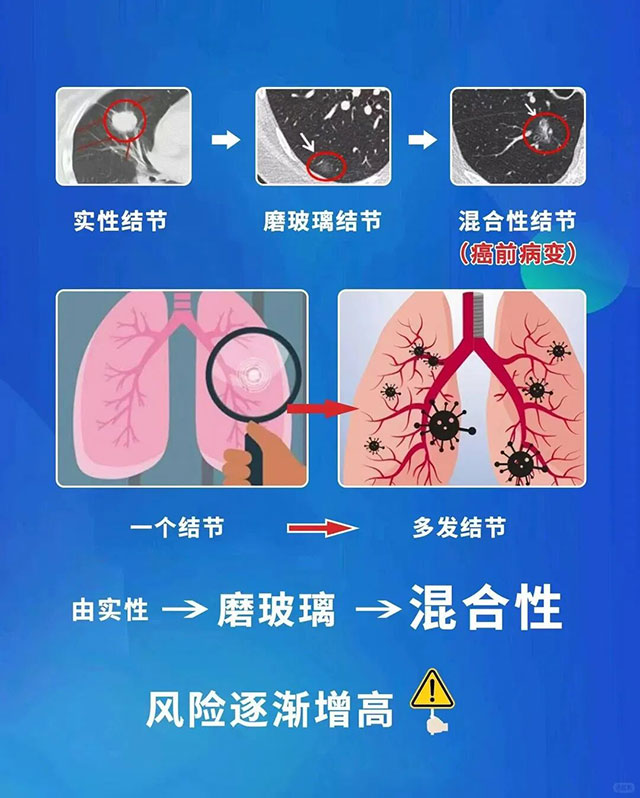 【科普】有肺结节?别慌!90%都是来“摸鱼”的→(图4) 4.jpg