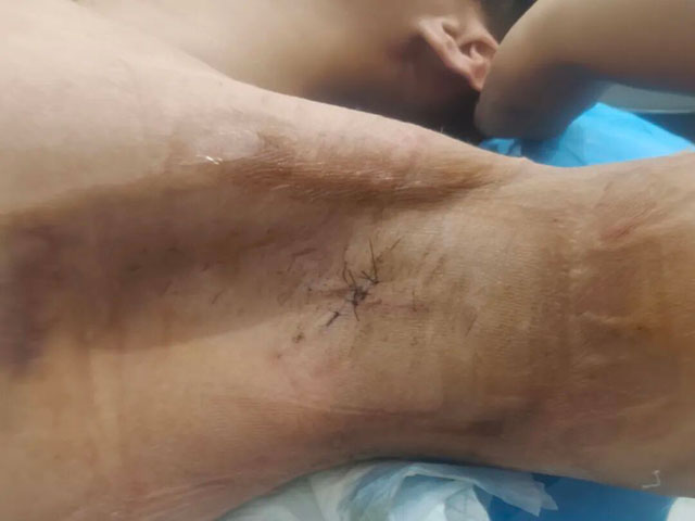 夏天不敢抬胳膊?别让“腋下小情绪”毁了您的社交自信!(图4) 4.jpg