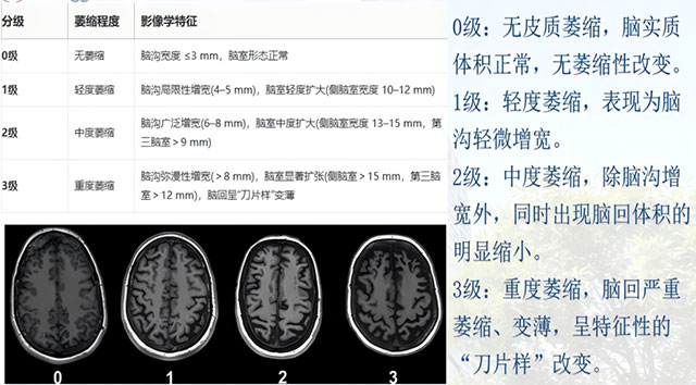 健忘、迷路、认错人,到底是不是“老年痴呆”?做这项检查就能揪出元凶(图5) 5.jpg