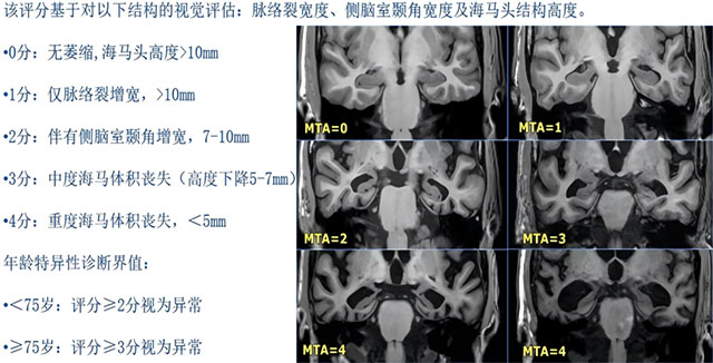 健忘、迷路、认错人,到底是不是“老年痴呆”?做这项检查就能揪出元凶(图6) 6.jpg