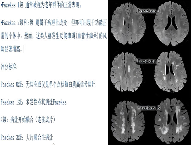 健忘、迷路、认错人,到底是不是“老年痴呆”?做这项检查就能揪出元凶(图7) 7.jpg