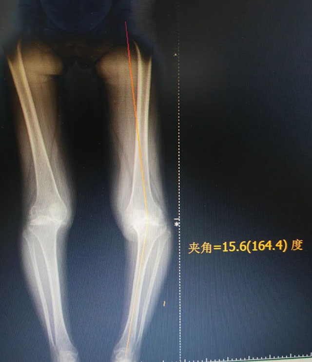 【岐黄攻坚】在得知只能换掉双膝,泸州孃孃……(图2) 2.jpg