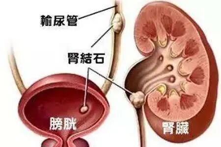 大学生减肥时突发绞痛,紧急入院救治!这些情况要注意……(图2) 肥2.jpg