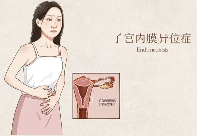 为什么有人经期痛到“打滚”?病理医生告诉你真正原因(图2) 病2.jpg