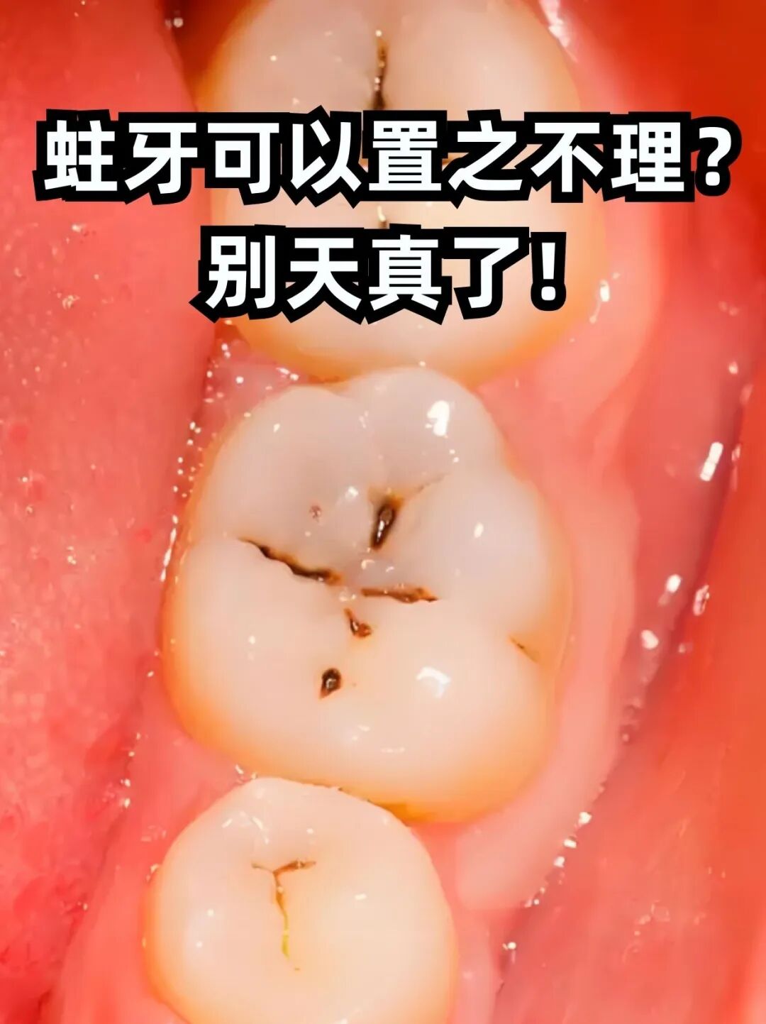 牙齿长黑点的人注意!(图1) 牙1.jpg