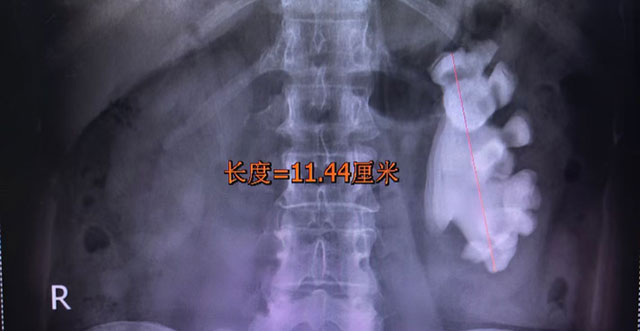要命!女子左肾被结石填满……这些情况不治,真要遭!(图2) 2.jpg