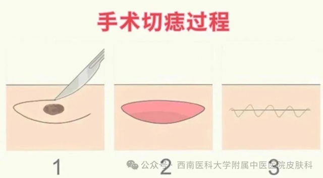 痣别乱点!激光vs手术怎么选?千万别踩坑(图3) 激光3.jpg