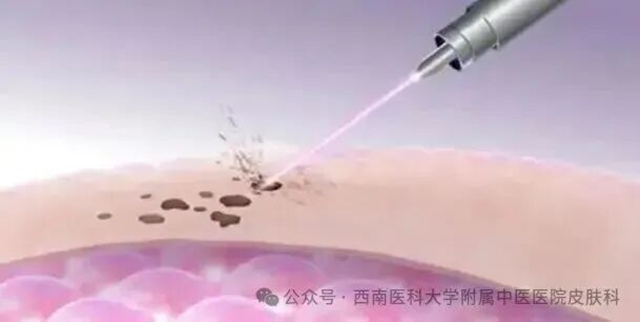 痣别乱点!激光vs手术怎么选?千万别踩坑(图1) 激光1.jpg