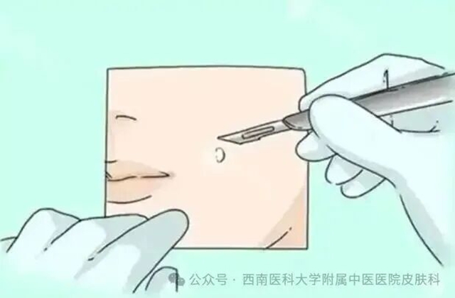 痣别乱点!激光vs手术怎么选?千万别踩坑(图2) 激光2.jpg