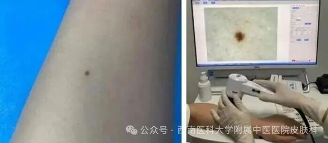 痣别乱点!激光vs手术怎么选?千万别踩坑(图4) 激光4.jpg