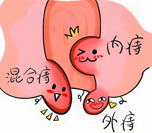 屁股的“难言之隐”,别总靠忍!(图4) 4.jpg