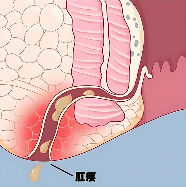 屁股的“难言之隐”,别总靠忍!(图6) 6.jpg