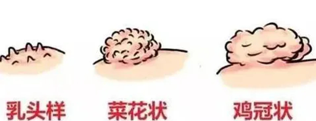 00后、05后女子外阴长“菜花”,确诊宫颈癌前病变!感染HPV后到底有多可怕(图3) 6.jpg