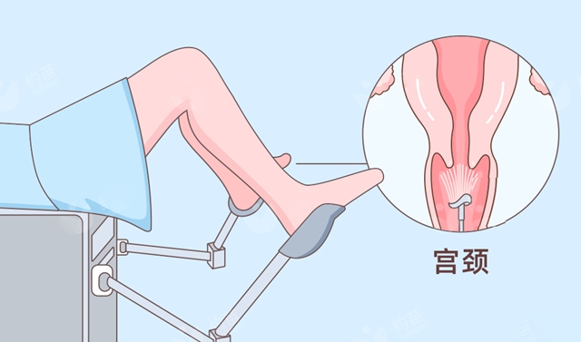 00后、05后女子外阴长“菜花”,确诊宫颈癌前病变!感染HPV后到底有多可怕(图7) 10.jpg