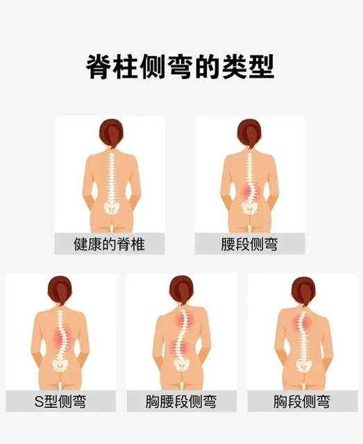 孩子查出脊柱侧弯,支具怎么选?(图3) 肯3.jpg