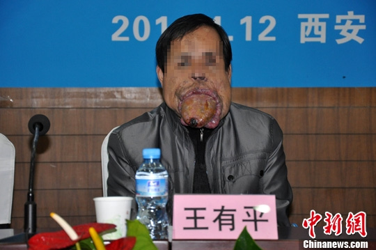 世界罕见"巨舌症"患者&nbsp;舌体约长25厘米(图1)