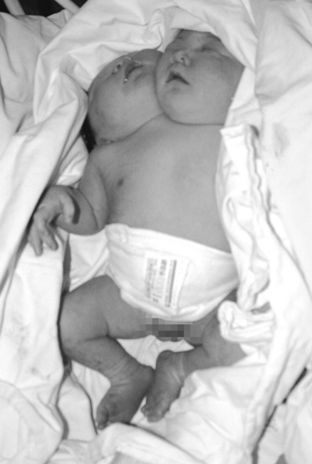 遂宁：国内首例“双头婴儿”降生(图1)