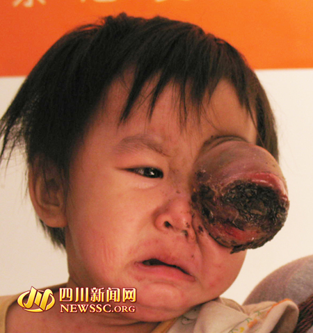 政府媒体网友爱心接力&nbsp;救助泸州眼肿瘤两岁女童(图1)