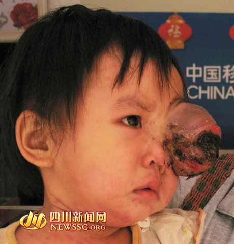 泸州两岁女童眼内长出拳头大肿瘤 无钱医治陷困境(图2) 泸州两岁女童眼内长出拳头大肿瘤 无钱医治陷困境(图2)