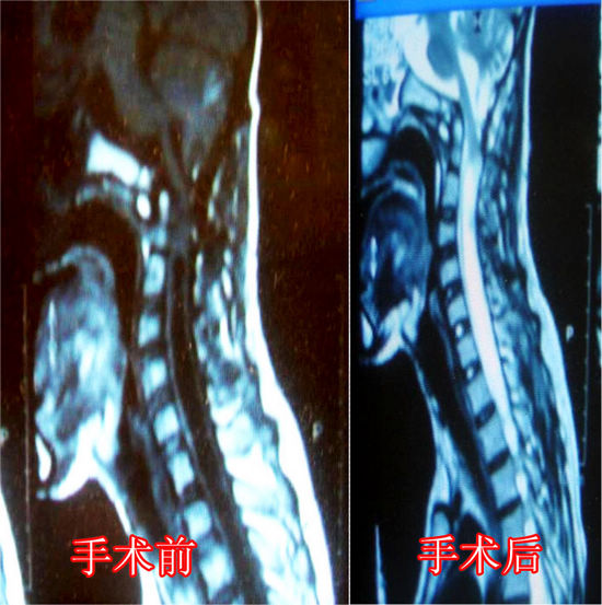 泸医附院治疗小脑扁桃体下疝畸形已取得好的效果(图1)