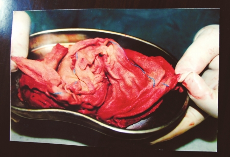 剖腹产后纱布留体内 主刀医生被停业一年(图2) 剖腹产后纱布留体内 主刀医生被停业一年(图2)