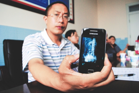 泸州合江:剖腹产后纱布留体内 主刀医生被停业一年(图1) 泸州合江:剖腹产后纱布留体内 主刀医生被停业一年(图1)