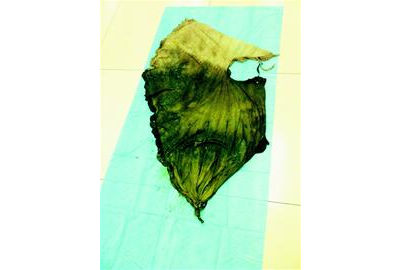 1米长布进肚子&nbsp;男子搞不清楚咋咽下肚