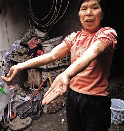 内江一妇女患怪病&nbsp;浑身长包块(图1)