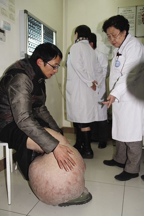 江安最美残疾教师巨型肿瘤“脱身”(图2)