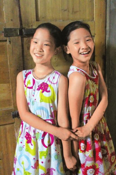 宜宾连体女婴分身9年 已与正常人无异(图1) 宜宾连体女婴分身9年 已与正常人无异(图1)