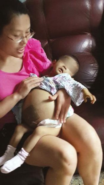 宜宾1岁女孩得怪病:肚皮大如鼓(图1)