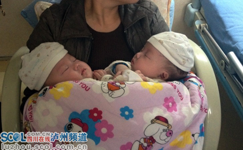 泸医附院第四例连体婴即将“单飞”(图1)