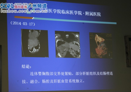 泸医附院第四例连体婴即将“单飞”(图2)