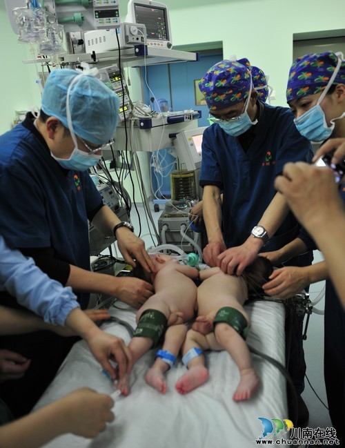 泸州“连体男婴”出生三个月后昨日成功分离(图2) 泸州“连体男婴”出生三个月后昨日成功分离(图2)