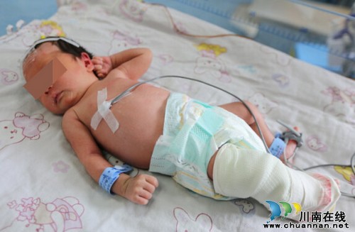 新生儿先天马蹄足&nbsp;泸医中医院为其成功实施手术(图1)