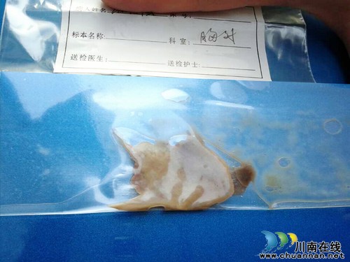 泸州7旬老汉食道卡鱼骨20多天 险些刺破主动脉(图2) 泸州7旬老汉食道卡鱼骨20多天 险些刺破主动脉(图2)