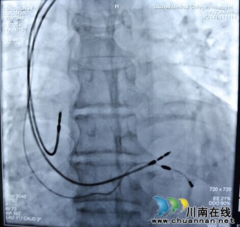 泸州:心脏再同步化治疗 点燃66岁老人"心"生命(图2) 泸州:心脏再同步化治疗 点燃66岁老人"心"生命(图2)